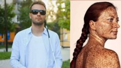 Umugabo yigize 'utabona' kugira ngo yisanishe n'umugore we wari urwaye indwara y'uruhu yamwangije isura