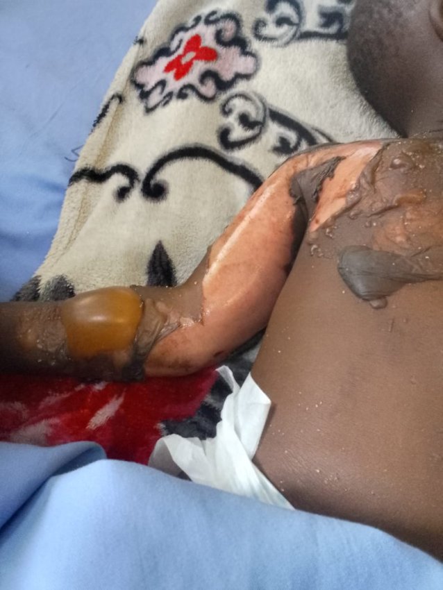 Rubavu: Ababyeyi b'abakristo baratabariza umwana wabo w'imyaka 2 wocyejwe n'igikoma gishyushye