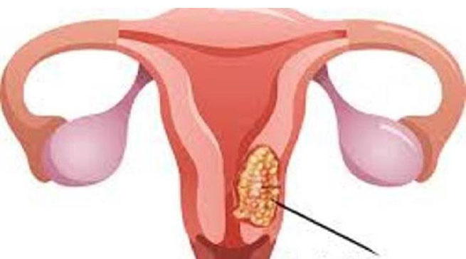 Abasaga 600 bicwa na kanseri y'inkondo y'umura buri mwaka - RBC